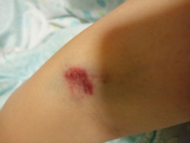 听林医生说 32岁秦女士以为是碰伤瘀血，结果示肝硬化，医生：预防肝硬化要好6个细节