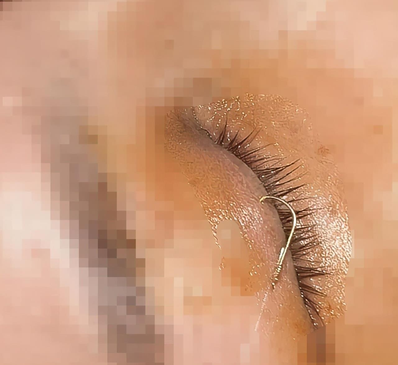 温州|钓鱼要冷静！温州男子钓鱼差点将女友眼睛“弄瞎”，就差3毫米！