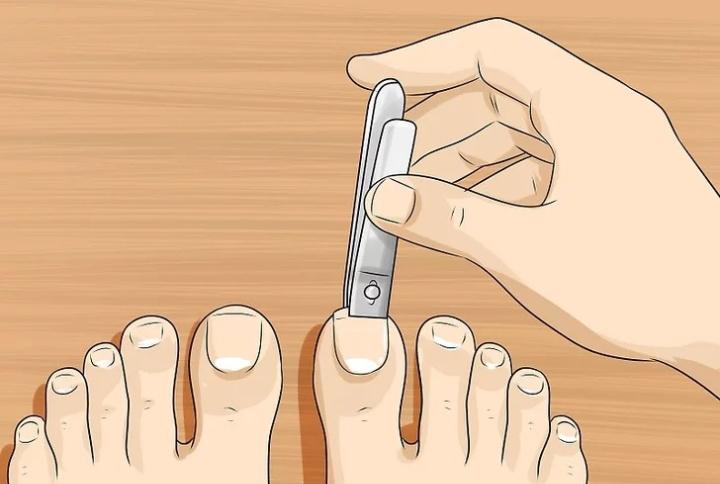 清源净流|你真的了解灰指甲吗？治疗灰指甲要避免五大误区