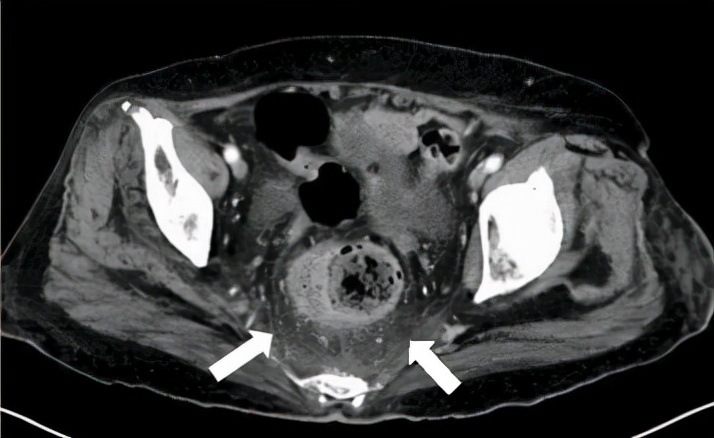 医生|癌症患者能活多久?医生坦言:主要看5个因素,金钱没那么重要