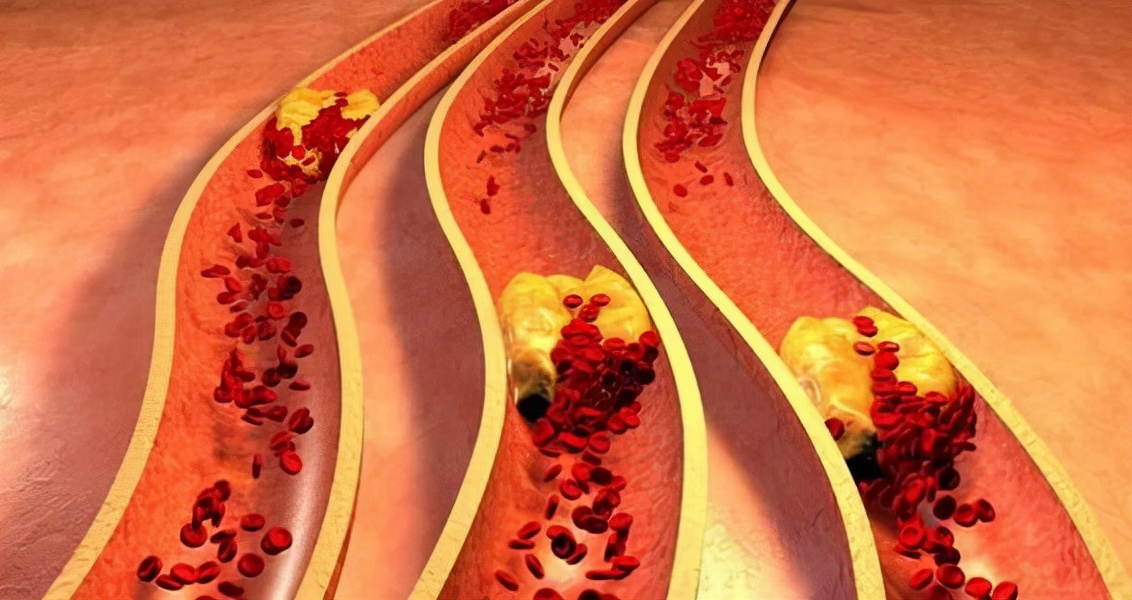 睡眠|睡觉有2个表现，多半血管已堵塞，医生：常吃1物，可给血管“洗个澡”