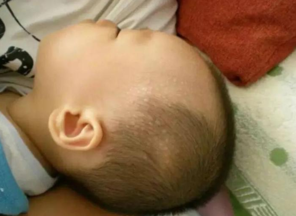 急诊室老苗|宝宝睡着就满头大汗，是因为“缺钙”吗？家长要学会判断