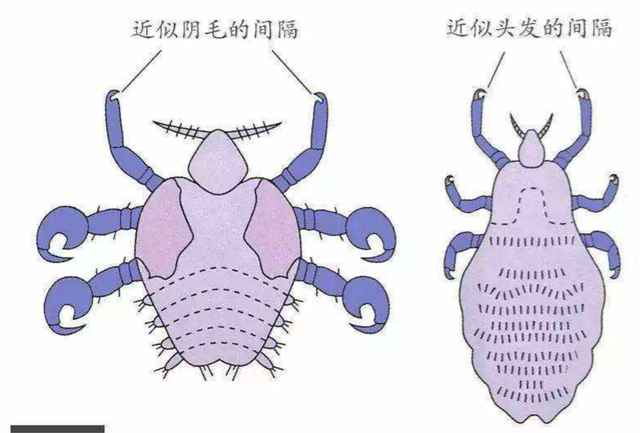  七八十年代，我们身上几乎都有虱子，为何后来忽然消失不见了？
