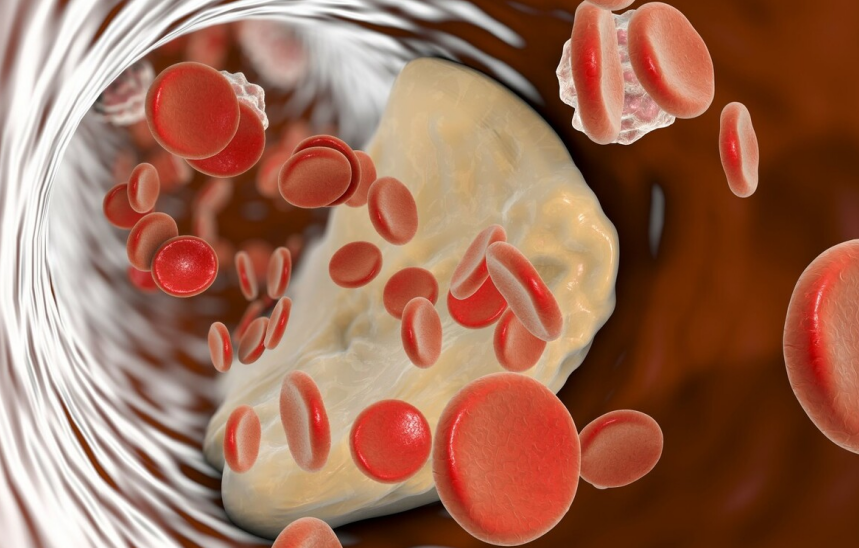 食盐|食盐是堵塞血管的“祸根”?医生苦劝:想要血管不堵,3种食物要少碰