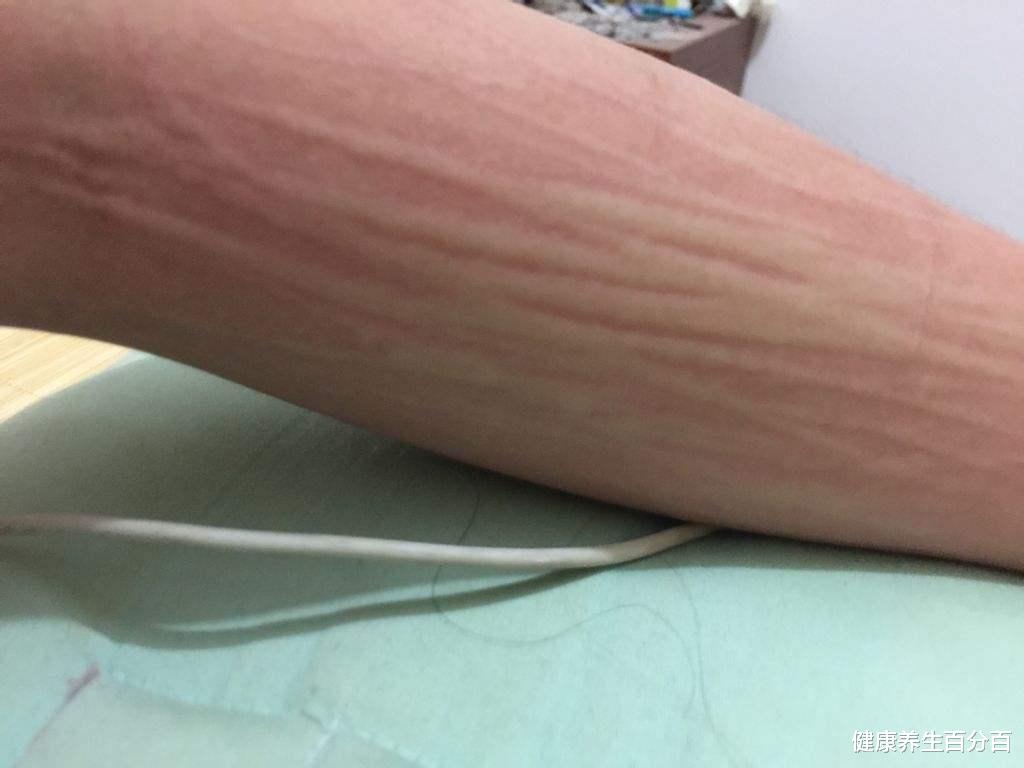 皮肤病|冬季皮肤病高发，这6种较常见！专家：找对病因，做好5点