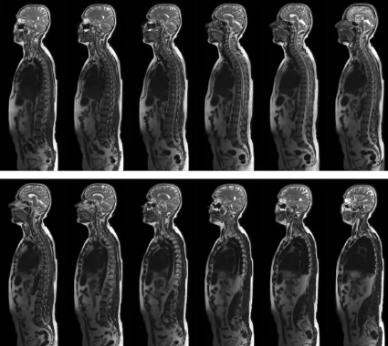 蛀牙|什么是腰椎滑移？