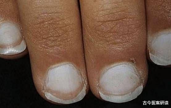 肝癌|肝癌“上身”，手部先知！医生：手部若有3种表现，趁早检查肝功