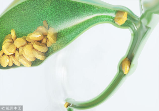 胆结石|胆结石，倪海厦老师常用基础方