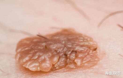 宫颈癌|大腿内侧有2个“信号”，或宫颈癌要来了，上厕所时，不妨留意下