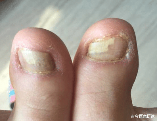 古今医案研读|身体4处“异常”，十有八九是肝病在伪装，医生：趁早去做肝检查！