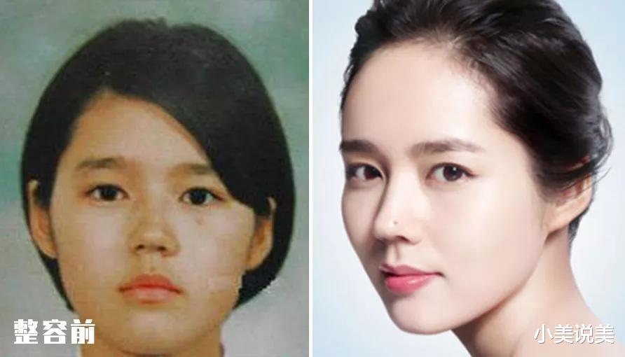 小美说美 究竟怎样才能整出自然、精致的鼻子呢?