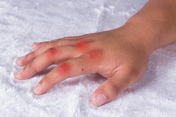 痛风|白酒不属于高嘌呤食物，为何有痛风的人也不能喝？2个原因别忽视