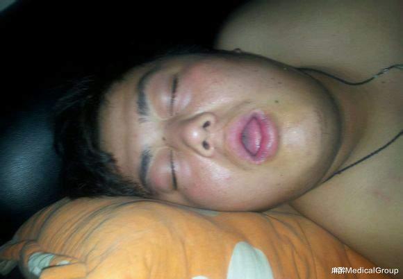 医生|200多斤的胖子走了，留下无助的妻儿，只因平时未重视打鼾问题