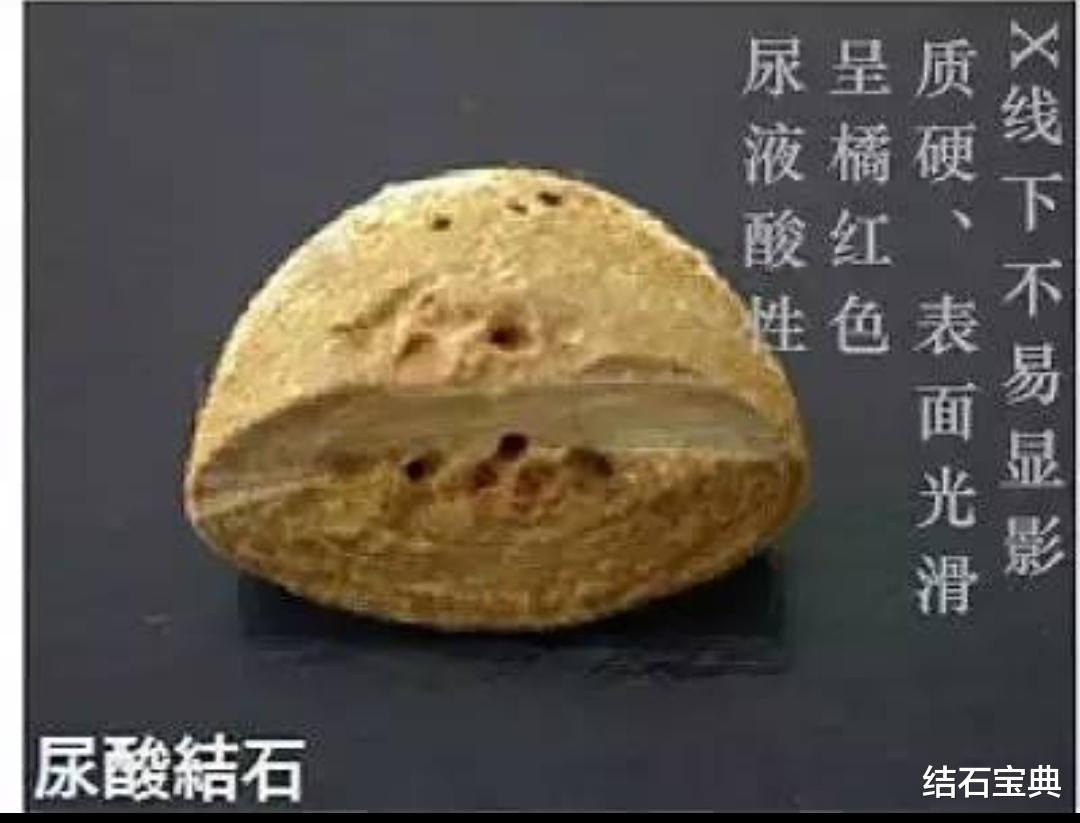 尿酸|尿酸结石的特点和治疗要点