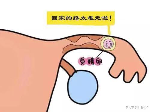 EVERLINK|宫外孕可以治成宫内孕吗？别交智商税！