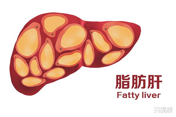 脂肪肝|长期不吃肉，只吃素食也会得脂肪肝？想减肥的人，该怎么吃？