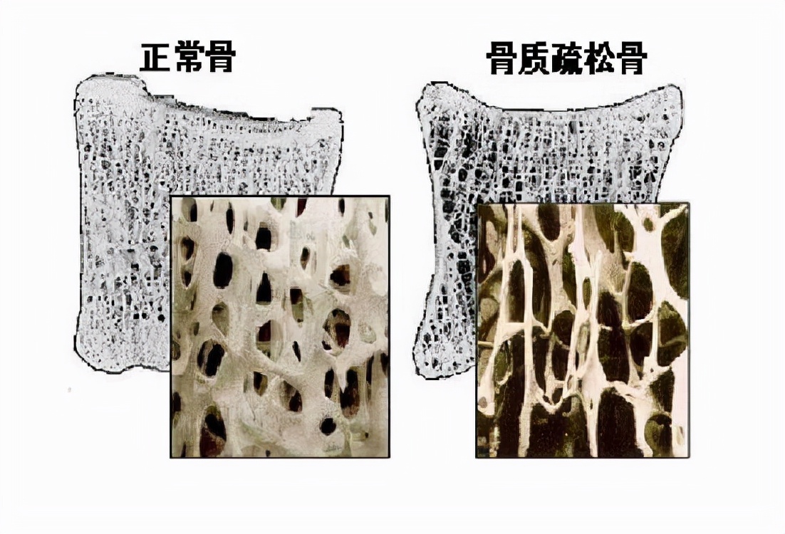 骨质疏松|上了年纪浑身疼痛？专家：常吃的2菜比醋还伤骨，小心骨头烂成豆腐渣