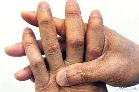 类风湿医生魏琳琳|最近戒指有点紧了，是我又胖了吗？手疾莫忽视，谨防类风湿! ! !
