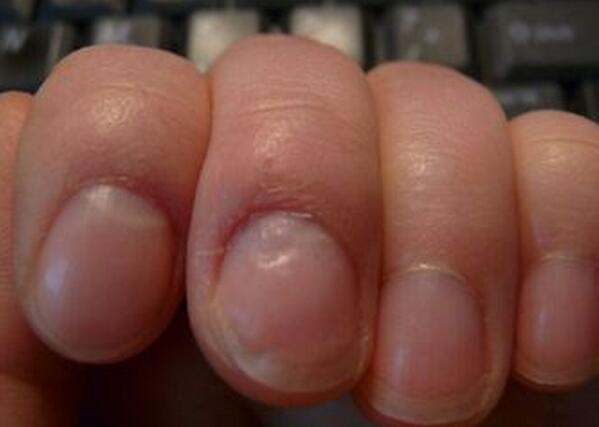 肝脏|指甲出现7个表现,肝脏可能出现了问题,请及时就诊检查!