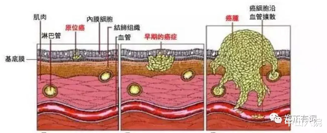 肺癌|那些被彻底治好的肺癌，都有啥特点？