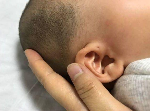 哑铃妈妈|娃耳朵上的“小孔”是聪明洞？医生通常不会明说，妈妈要心知肚明