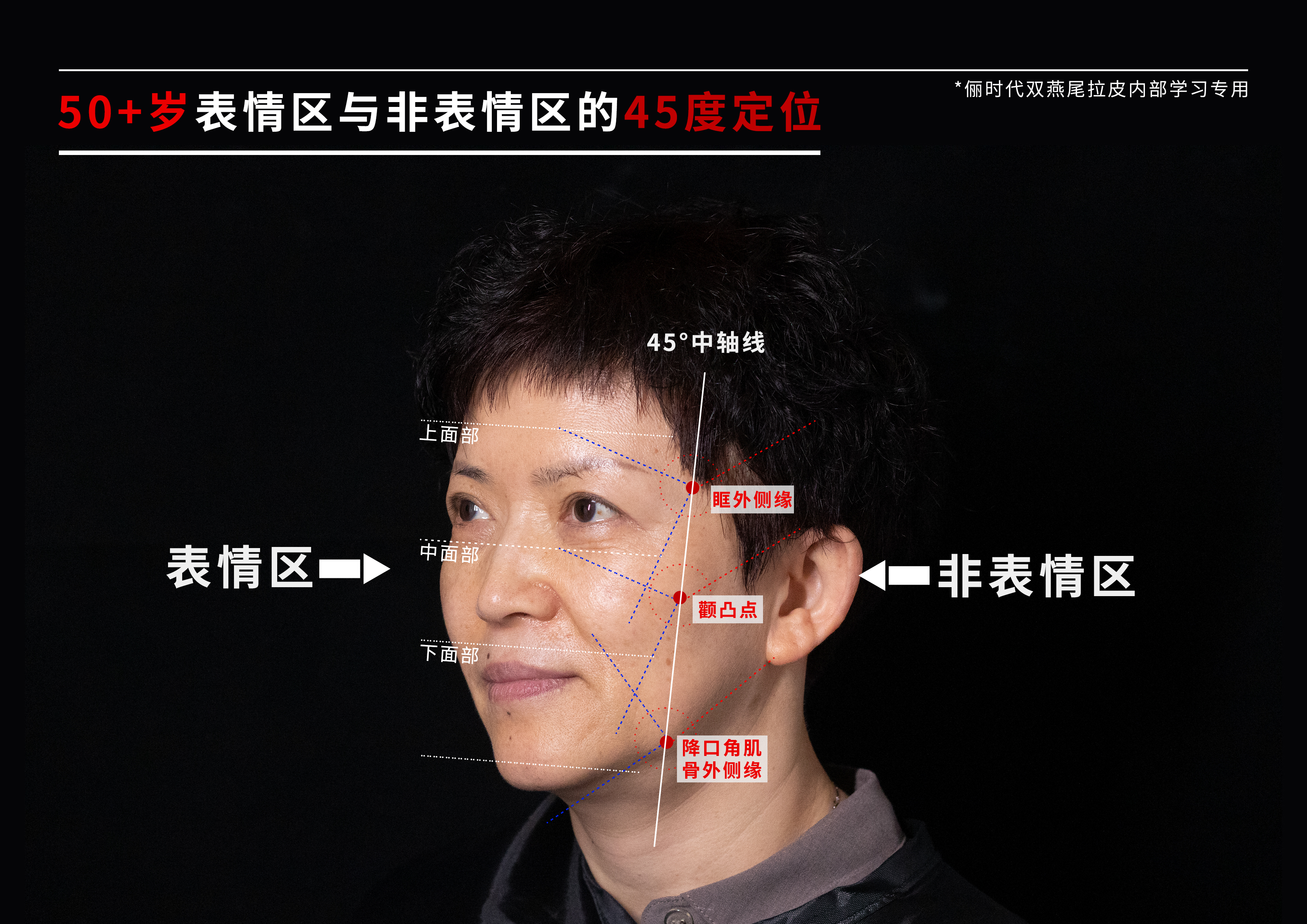 拉皮医生张永 如何体现面部高级感？你需要了解45°表情区和非表情区