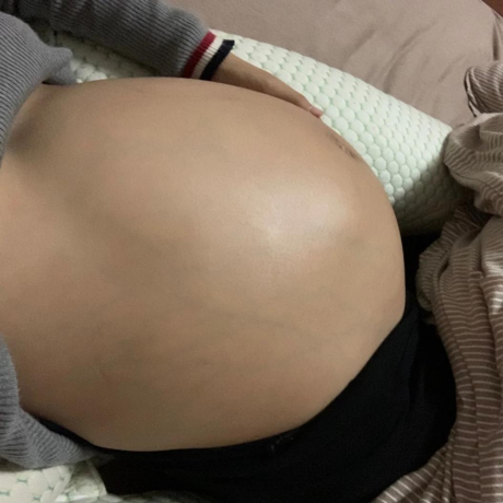 樱桃妈咪|有长纹基因也能逆天改命？预防妊娠纹，务必做好这些事，别懈怠！