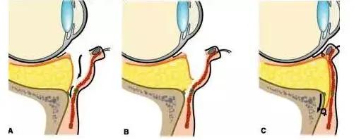 小美说美|做眼袋手术多长时间能恢复正常
