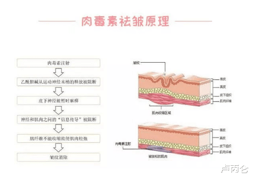卢丙仑|涂抹式肉毒素是智商税吗？