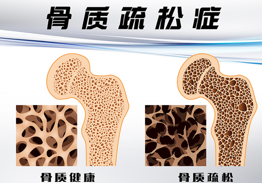 葡萄干|吃一口堪比喝5斤碳酸饮料，骨科教授：你若常吃，小心骨头“酥掉渣”