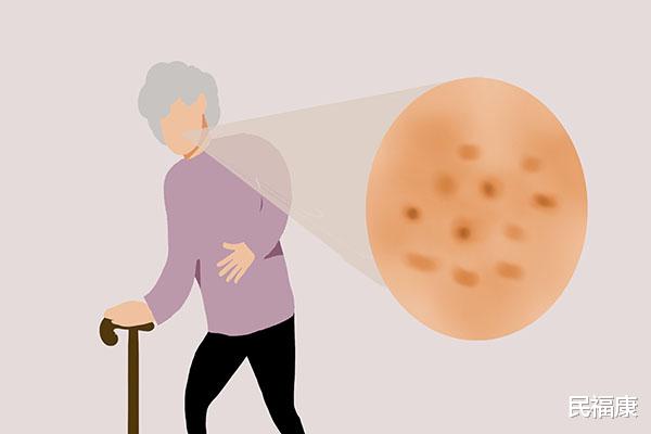 老年斑|为何人老了会长老年斑?影响健康吗?有些年轻人也长,是咋回事?