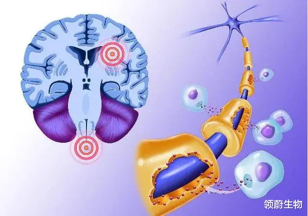 多发性硬化症|在研干细胞新药完成首例多发性硬化症患者用药，欲知临床疗效看这