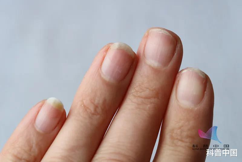 真菌感染|涨知识！原来指甲有斑点、竖纹、变厚竟预示着这些病…