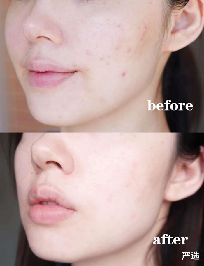 美容仪|女子为变美“不择手段”，脸上埋下百根“金丝”，现在怎样了？