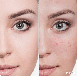 伊美如云|消除痘印黑色素，你必须知道这几件事