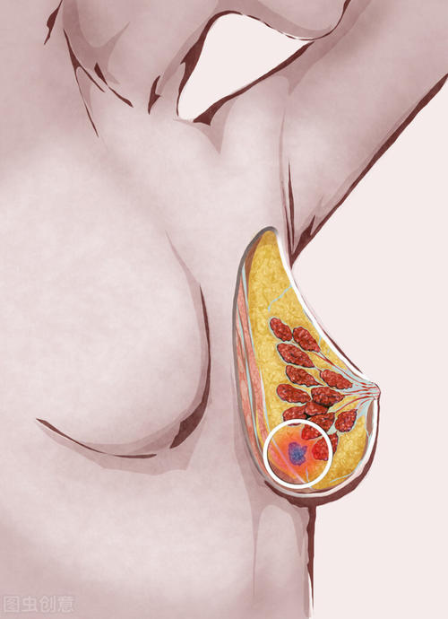 橘子|2級以下的乳腺增生結節，兩味中藥搭配泡水喝，化痰、疏肝散結，請體會！