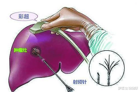 罗医生说健康 发现时已肝癌晚期，5年后，他为自己还活着而庆祝