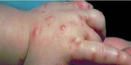 小菜鸟飞啊飞 红火蚁咬了红肿痒用什么药比较好？最怕什么？擦这四种药效果好！