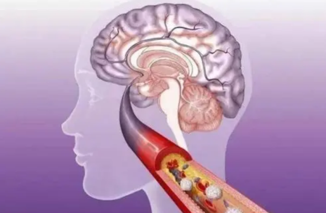 甘油|45岁大叔半年甘油三酯从5.4到1.6，内科主任：2种素食不妨多吃