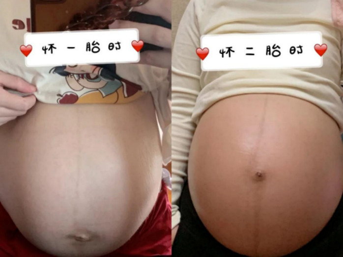 爱吃糖果的辣妈|生完两个娃产后几乎没有妊娠纹？孕期做好这几件，轻松远离花皮肚