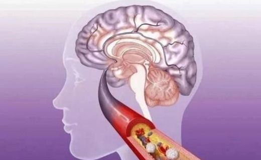 肾病|“胆固醇”大户被发现,猪肉落榜,不想脑梗上门,尽量少吃