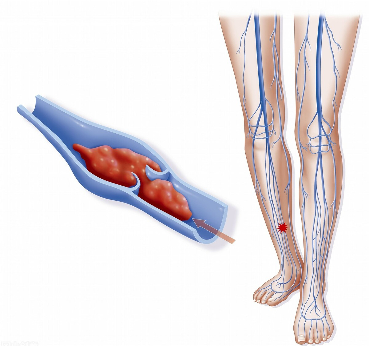血栓|通塞脉片,益气养阴、活血化瘀,打通闭塞血脉,防治6种微血管病
