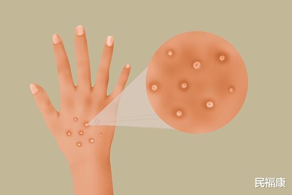 汗疱疹|每到夏季手上就容易长出小水泡,还有点痒,到底是啥?该怎么办?