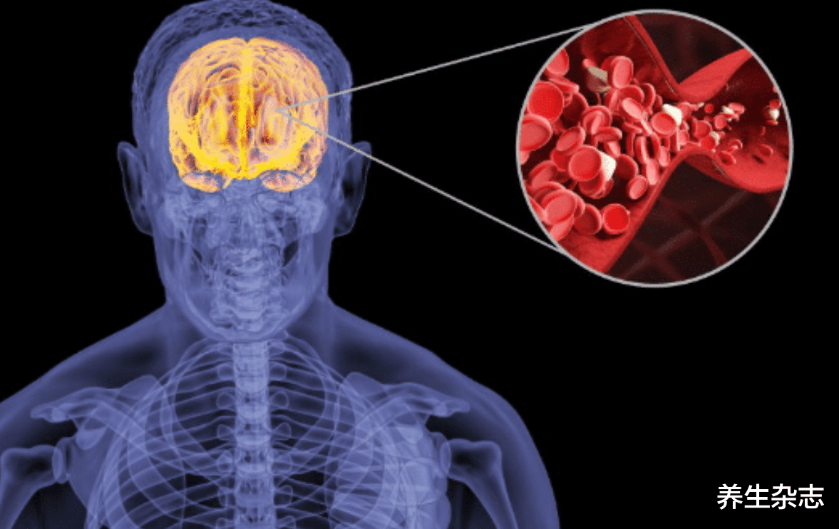 红豆|脑梗多半是吃出来的，医生提醒：脸上出现2处异常，尽快检查脑CT