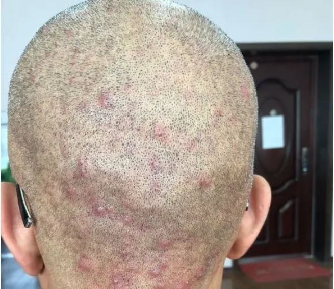 银屑病|为什么头皮上总长红疙瘩和脓包?是什么引起的?不是小事,得当心