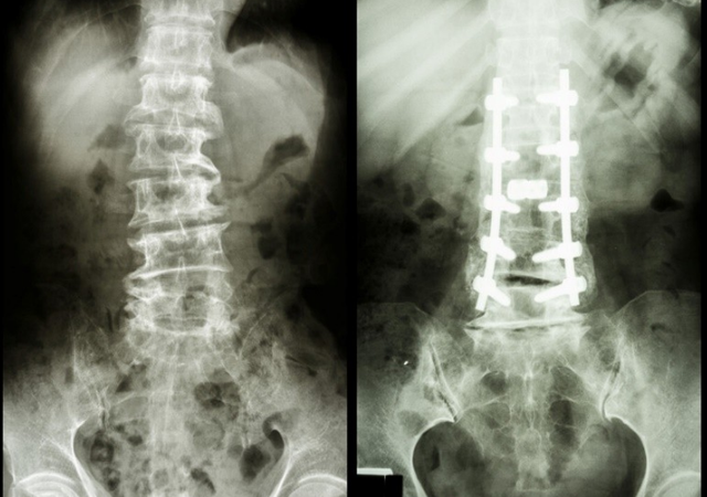 水煮蛋|88岁骨科院士研究骨病60年，提示：3种食物是烂骨王，尽量少吃