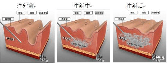 严选|周迅无法面对衰老在家哭，医美抗衰老风险大，如何正确抗衰老？