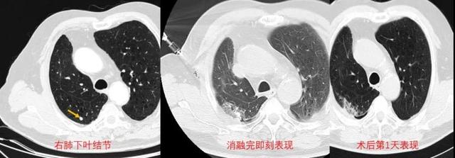 更年期|精准!不开刀“融”化肺肿瘤 助七旬老人点亮生命