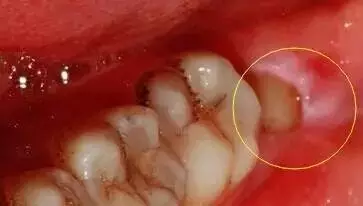 运动|智齿到底要不要拔？你该做决定了！