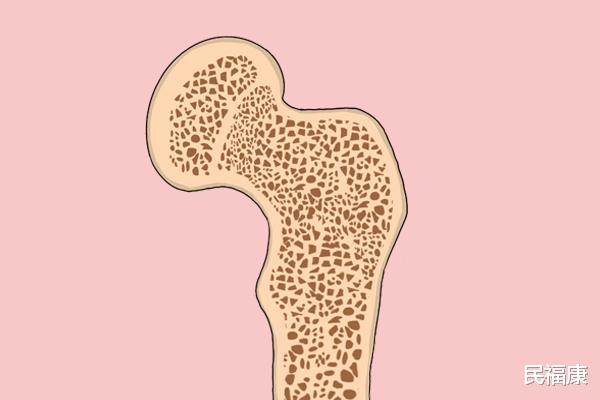 骨关节炎|女性60岁后,为啥容易患骨关节炎?吃氨糖能不能治疗骨关节炎?